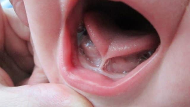 ANQUILOGLOSIA (Frenillo Corto) ¿CÓMO LO TRATAMOS?