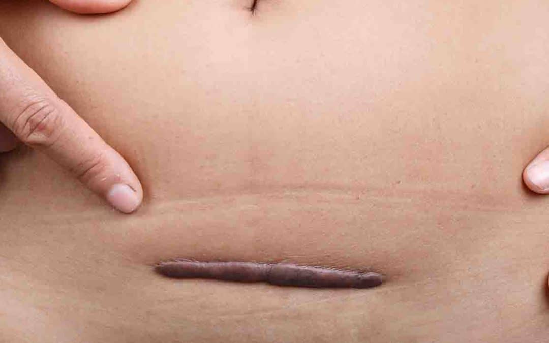 CICATRICES POSPARTO: SE PUEDEN ELIMINAR